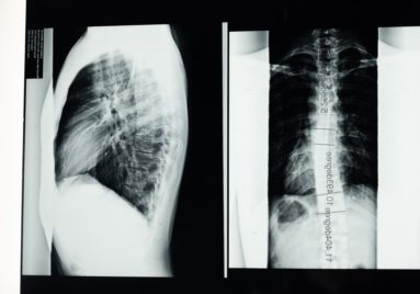 spinal xrays